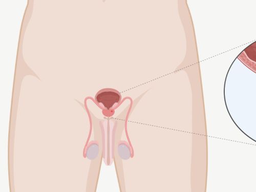 Grafische Darstellung der Lage der Geschlechtsorgane, Harnblase, Harnröhre. In der Prostata befindet sich ein Tumor (rot).