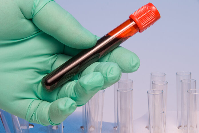 Blutprobe, Robert Byron, Thinkstock Blutprobenröhrchen in einer Hand, im Hintergrund sind Reagenzgläser.