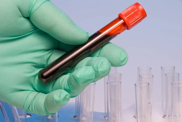 Blutprobe, Robert Byron, Thinkstock Blutprobenröhrchen in einer Hand, im Hintergrund sind Reagenzgläser.