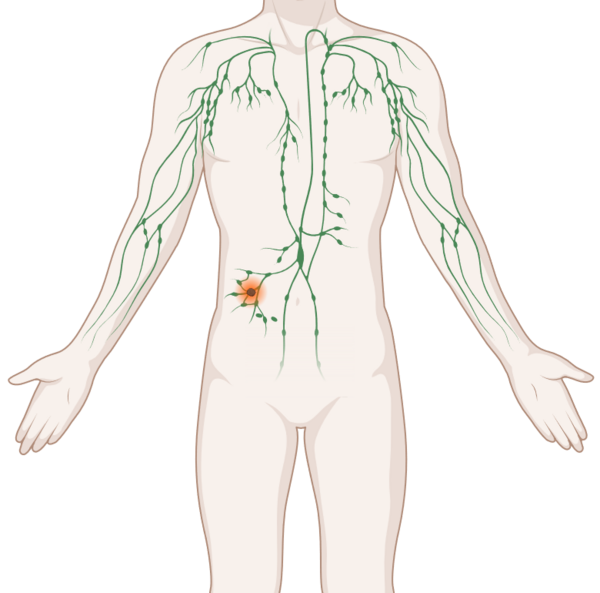 Schematische, anatomische Darstellung des lymphatischen Systems mit leuchtendem Tumor.