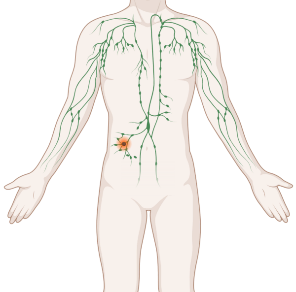 Lymphome, © Krebsinformationsdienst, DKFZ; erstellt mit Biorender.com Schematische, anatomische Darstellung des lymphatischen Systems mit leuchtendem Tumor.