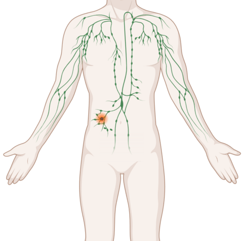 Schematische, anatomische Darstellung des lymphatischen Systems mit leuchtendem Tumor.
