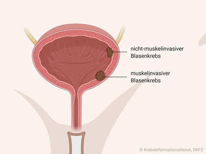 Blasenkrebs-Stadien, © Krebsinformationsdienst, DKFZ; erstellt mit BioRender.com Nicht-muskelinvasiver Blasenkrebs ist auf die Blasenschleimhaut begrenzt, muskelinvasiver Blasenkrebs ist weiter in die Muskelschicht eingewachsen.