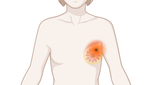Brust mit Tumor, © Krebsinformationsdienst, DKFZ; erstellt mit Biorender.com Oberkörper eine Frau mit leuchtendem Tumor an der Brust