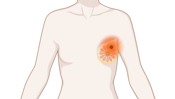 Brust mit Tumor, © Krebsinformationsdienst, DKFZ; erstellt mit Biorender.com Oberkörper eine Frau mit leuchtendem Tumor an der Brust