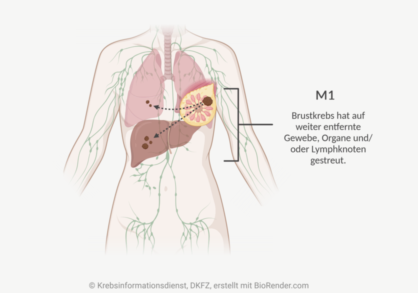 M-Status bei Brustkrebs, © Krebsinformationsdienst, DKFZ; erstellt mit BioRender.com Infografik eines weiblichen Rumpfes mit dem lymphatischen System, einigen inneren Organen, einem Tumor in der linken Brust und Metastasen in der Lunge und der Leber.