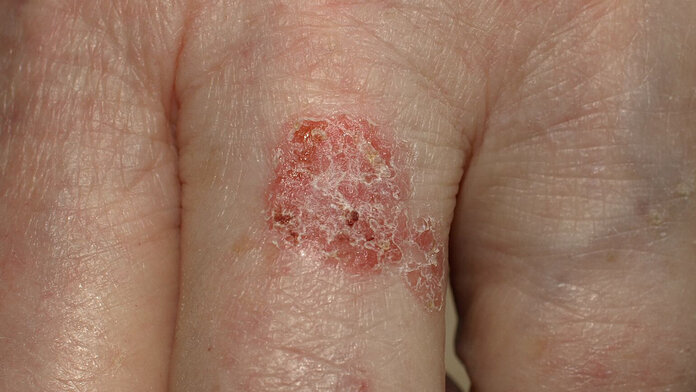 Eine fleckenförmige, gerötete, schuppige Hautveränderung (Morbus Bowen) auf dem Finger einer Hand.