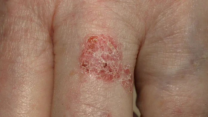 Eine fleckenförmige, gerötete, schuppige Hautveränderung (Morbus Bowen) auf dem Finger einer Hand.