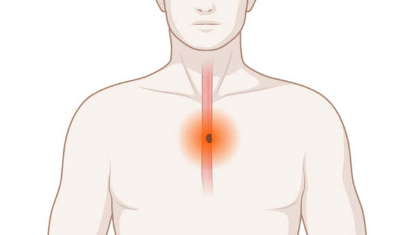 Speiseröhrenkrebs, © Krebsinformationsdienst, DKFZ; erstellt mit BioRender.com Schematische, anatomische Darstellung der Speiseröhre mit leuchtendem Tumor
