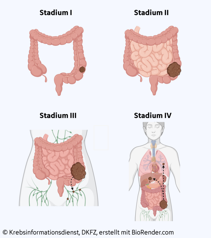 Stadieneinteilung bei Darmkrebs, © Krebsinformationsdienst, DKFZ; erstellt mit BioRender.com Stadieneinteilung bei Darmkrebs: Stadium I: Tumor auf den Darm begrenzt, Stadium II: Ausbreitung in umliegende Organe, Stadium III: Ausbreitung in Lymphknoten, Stadium IV: Fernmetastasen