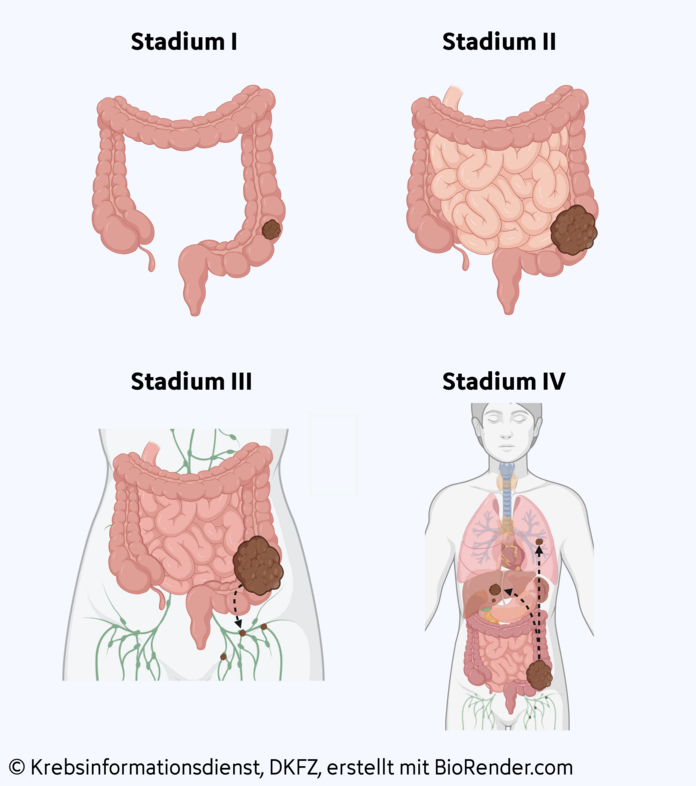 Stadieneinteilung bei Darmkrebs, © Krebsinformationsdienst, DKFZ; erstellt mit BioRender.com Stadieneinteilung bei Darmkrebs: Stadium I: Tumor auf den Darm begrenzt, Stadium II: Ausbreitung in umliegende Organe, Stadium III: Ausbreitung in Lymphknoten, Stadium IV: Fernmetastasen