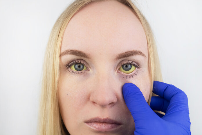 Gelbsucht , © Alona Siniehina, iStock Junge Frau mit gelb verfärbten Augen. Der Fachbgeriff dafür lautet Ikterus.