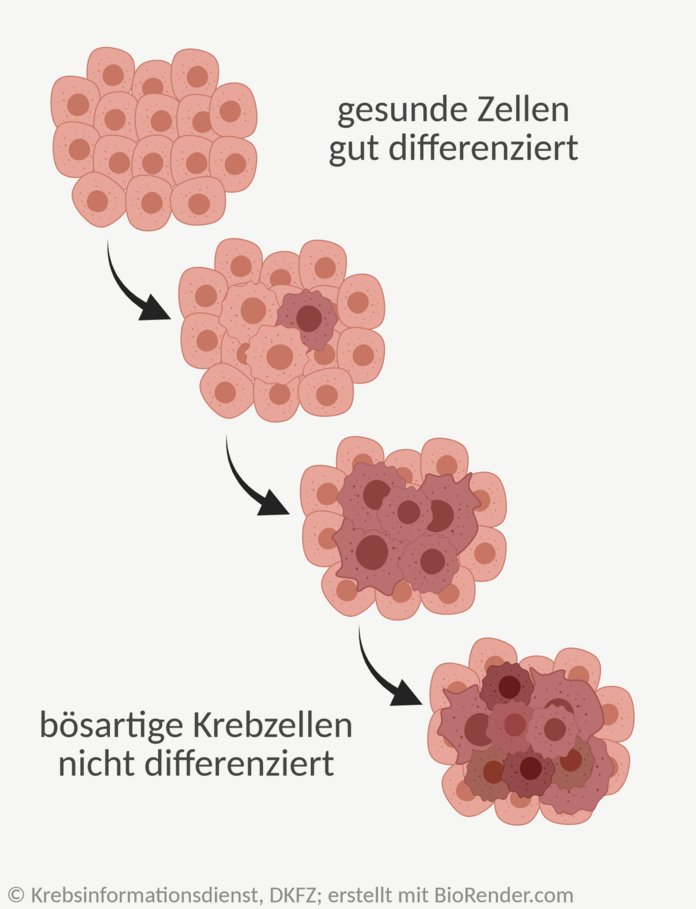 Grafik: Darstellung der Veränderungen von gesunden Zellen zu bösartigen Tumorzellen.