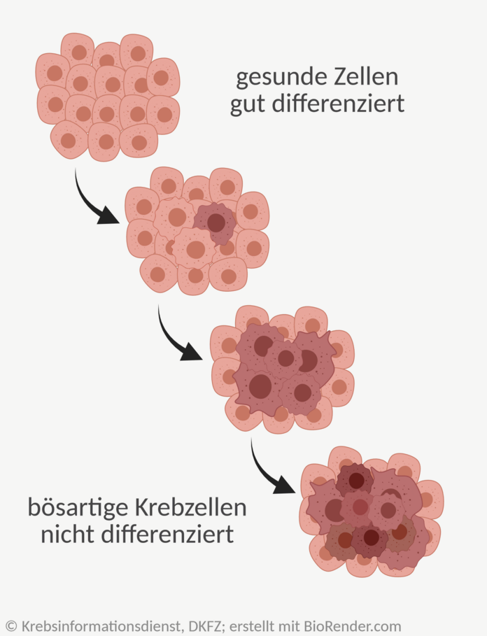 Grafik: Darstellung der Veränderungen von gesunden Zellen zu bösartigen Tumorzellen.