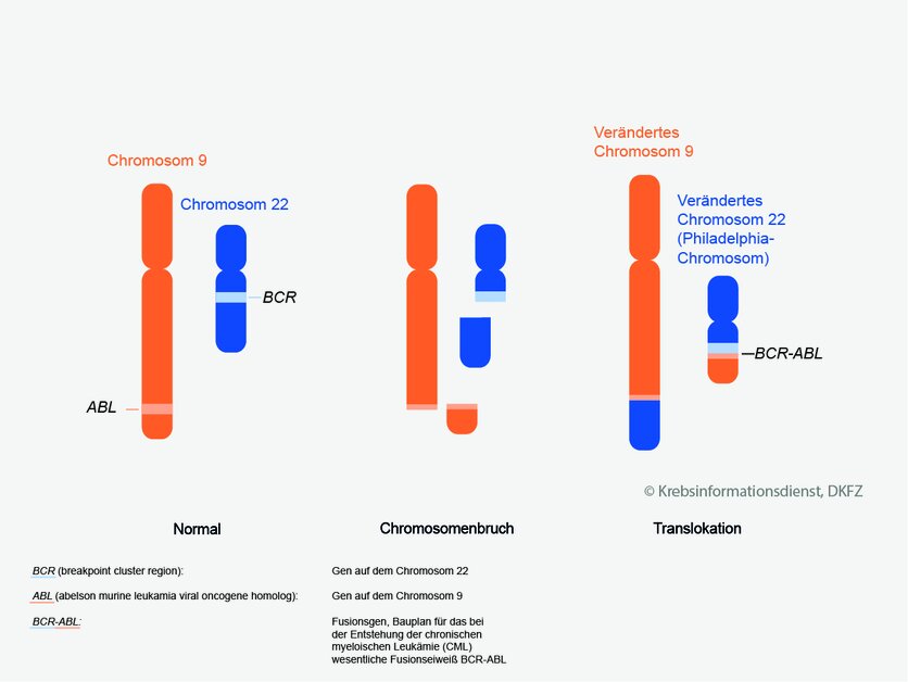 Translokation bei Philadelphia-Chromosom, © Krebsinformationsdienst, DKFZ; Grafik: Asena Tunali Translokation bei Philadelphia-Chromosom