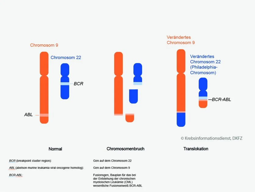 Translokation bei Philadelphia-Chromosom, © Krebsinformationsdienst, DKFZ; Grafik: Asena Tunali Translokation bei Philadelphia-Chromosom