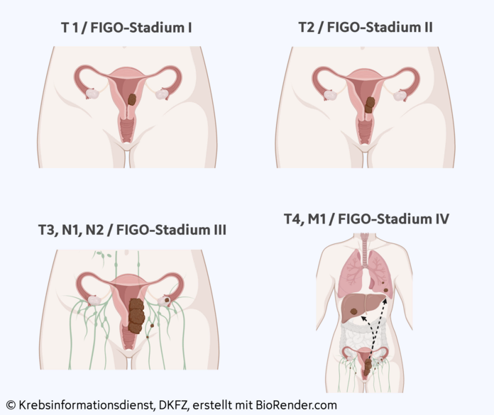 Mit dem Krankheitsstadium beschreiben Ärzte, wie weit sich Gebärmutterkörperkrebs ausgebreitet hat., © Krebsinformationsdienst, DKFZ; erstellt mit BioRender.com Mit dem Krankheitsstadium beschreiben Ärzte, wie weit sich Gebärmutterkörperkrebs ausgebreitet hat.