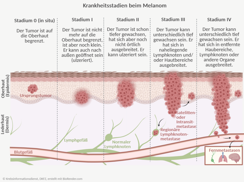 Infografik zum Verlauf einer Melanom-Erkrankung. Zu sehen ist der Ursprungstumor, der mit weiterem Krankheitsverlauf größer wird. Auch der Prozess der Tumorabsiedlung in Blutgefäße und/oder Lymphgefäße ist abgebildet.,