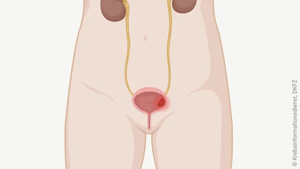 Blasenkrebs: Tumor in der Harnblase, © Krebsinformationsdienst, DKFZ; erstellt mit Biorender.com Schematische Darstellung der ableitenden Harnwege mit Nieren, Harnleiter, Harnblase und Harnröhre