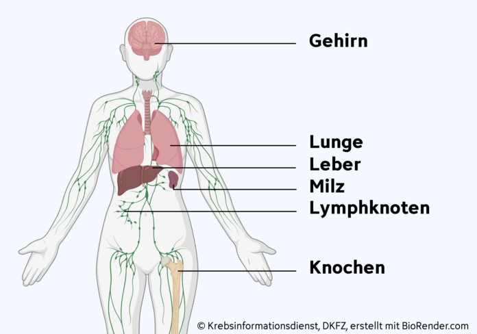Häufige Fernmetastasen bei fortgeschrittenem Eierstockkrebs, © Krebsinformationsdienst, DKFZ; erstellt mit Biorender.com Grafische Darstellung des Körpers und verschiedener Organe, die beschriftet sind: Gehirn, Lunge, Leber, Milz, Lymphknoten und Knochen.