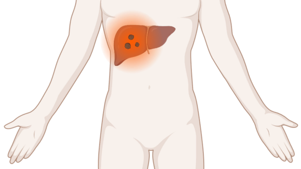 Lebermetastasen, © Krebsinformationsdienst, DKFZ; erstellt mit BioRender.com Schematische, anatomische Darstellung des Körpers mit mehreren leuchtenden Tumoren (Metastasen) in der Leber.