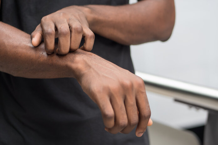 Juckreiz, © 9nong, Shutterstock.com Eine Hand kratzt die Haut am Unterarm wegen Hautjucken