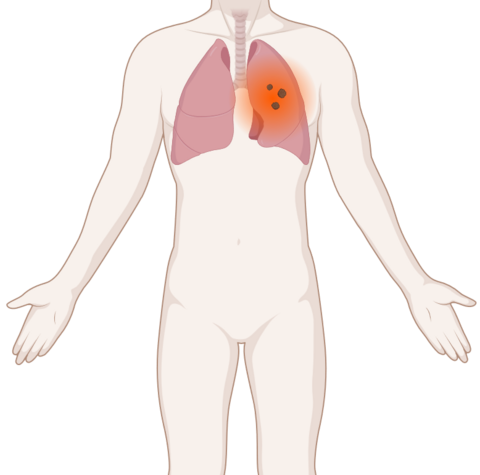 Schematische, anatomische Darstellung des Körpers mit mehreren leuchtenden Tumoren (Metastasen) in der Lunge.
