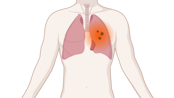 Schematische, anatomische Darstellung des Körpers mit mehreren leuchtenden Tumoren (Metastasen) in der Lunge.