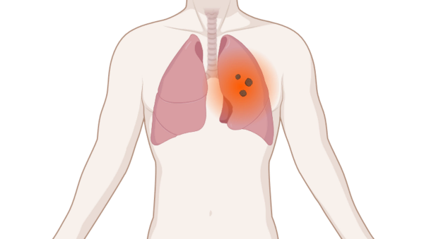 Lungenmetastasen, © Krebsinformationsdienst, DKFZ; erstellt mit BioRender.com Schematische, anatomische Darstellung des Körpers mit mehreren leuchtenden Tumoren (Metastasen) in der Lunge.