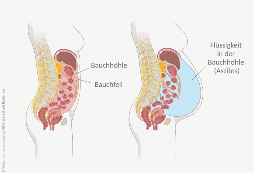 Aszites, © Krebsinformationsdienst, DKFZ; erstellt mit BioRender.com Grafische Darstellung des Bauchraums. Bei einem Aszites sammelt sich so viel Flüssigkeit in der Bauchhöhle, dass sich der Bauch vorwölbt.