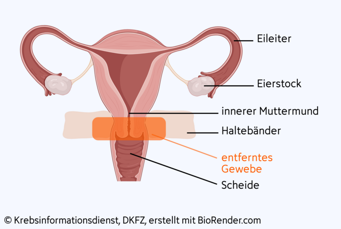 Anatomische Darstellung der Gebärmutter mit den Geweben, die bei der Trachelektomie herausoperiert werden.
