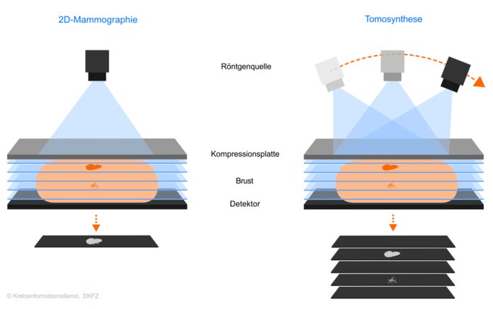Neue Technik für die Brustkrebsdiagnostik – im Vergleich zur herkömmlichen Mammographie, © Krebsinformationsdienst, DKFZ Die Grafik zeigt schematisch eine komprimierte Brust mit 2 übereinanderliegenden krebsverdächtigen Veränderungen. Darüber befindet sich die Röntgenquelle. Bei der Tomosynthese (rechte Bildhälfte) nimmt die Röntgenquelle Bilder aus verschiedenen Winkeln auf. Die unter der Brust abgebildeten Schichtbilder 1 - 5 zeigen die Veränderungen in der entsprechenden Gewebeschicht jeweils scharf und deutlich. In der linken Bildhälfte ist zum Vergleich die herkömmliche 2D-Mammographie zu sehen, bei der sich die 2 Veränderungen überlagern.