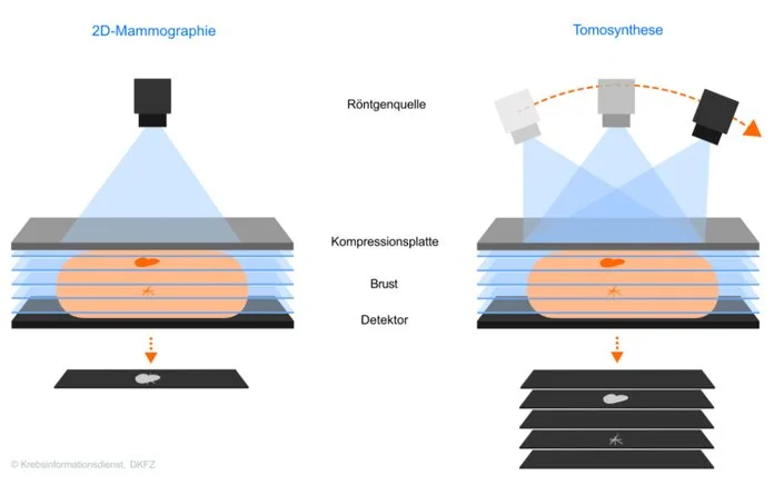 Neue Technik für die Brustkrebsdiagnostik – im Vergleich zur herkömmlichen Mammographie, © Krebsinformationsdienst, DKFZ Die Grafik zeigt schematisch eine komprimierte Brust mit 2 übereinanderliegenden krebsverdächtigen Veränderungen. Darüber befindet sich die Röntgenquelle. Bei der Tomosynthese (rechte Bildhälfte) nimmt die Röntgenquelle Bilder aus verschiedenen Winkeln auf. Die unter der Brust abgebildeten Schichtbilder 1 - 5 zeigen die Veränderungen in der entsprechenden Gewebeschicht jeweils scharf und deutlich. In der linken Bildhälfte ist zum Vergleich die herkömmliche 2D-Mammographie zu sehen, bei der sich die 2 Veränderungen überlagern.