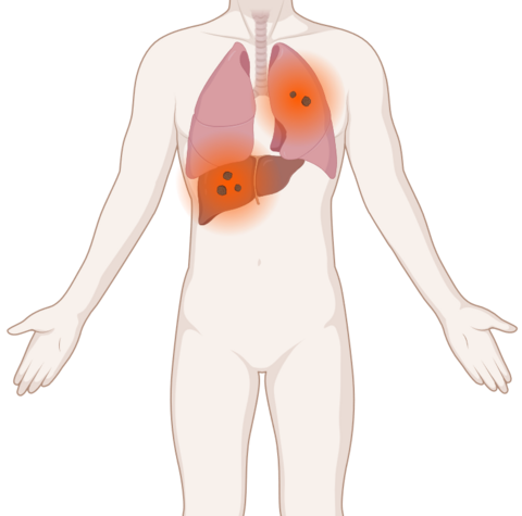 Schematische, anatomische Darstellung der Lunge und Leber mit leuchtenden Tumoren