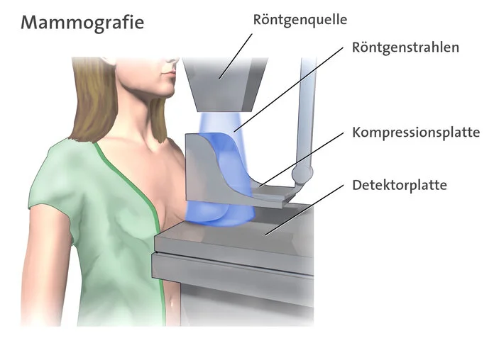 Infografik, die zeigt, wie eine Frau am Mammographie-Gerät steht und ihre Brust geröngt wird. Der Aufbau des Geräts ist mit Röntgenquelle, Röntgenstrahlen, Kompressionsplatte und Detektorplatte beschriftet.