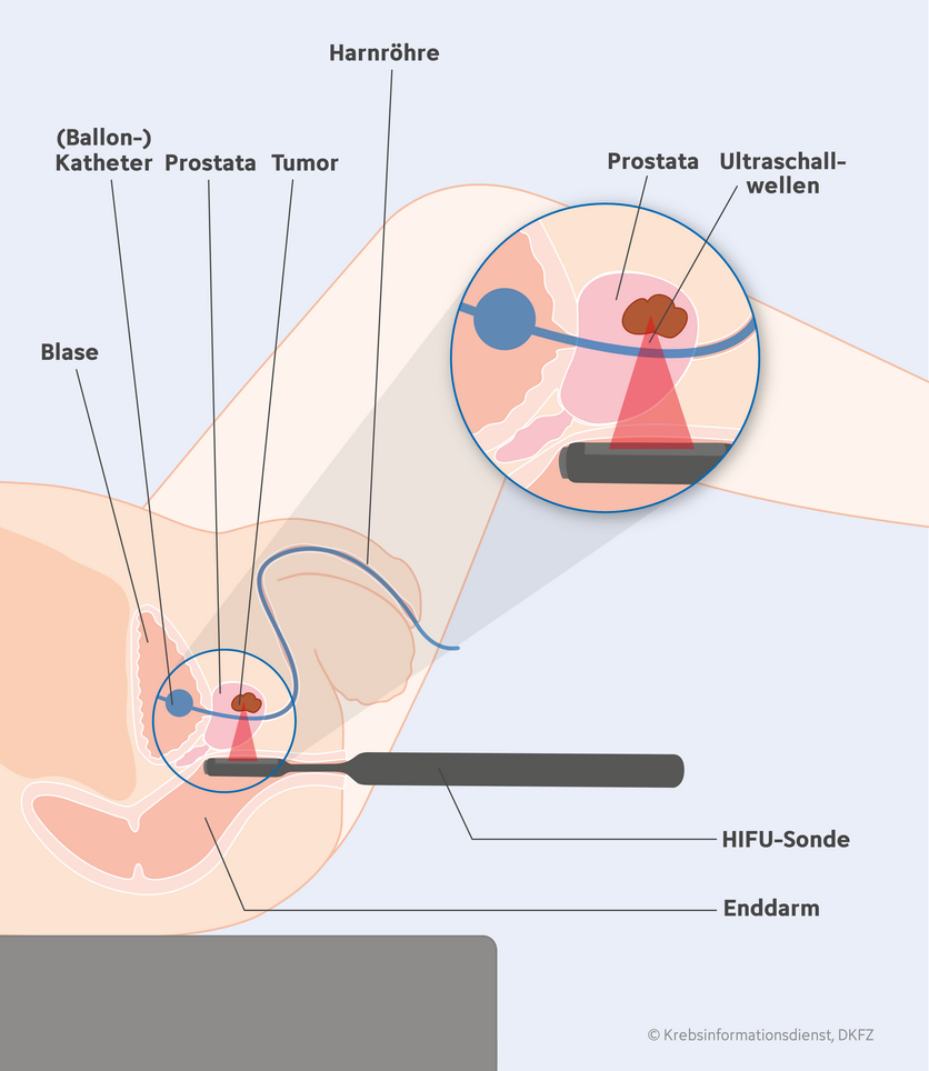 Fokaler hochintensiver, fokussierter Ultraschall (HIFU) bei Prostatakrebs, © Krebsinformationsdienst, DKFZ; erstellt von Anna Diechtierow Grafische Darstellung einer fokalen HIFU bei Prostatakrebs.