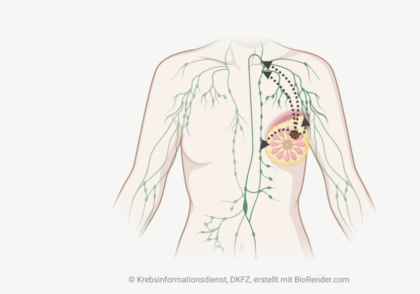 N-Status bei Brustkrebs, © Krebsinformationsdienst, DKFZ; erstellt mit BioRender.com Infografik eines weiblichen Oberkörpers mit dem lymphatischen System und einem Tumor in der linken Brust. Pfeile deuten an, wie Krebszellen in umliegende Lymphknoten des Tumors wandern.