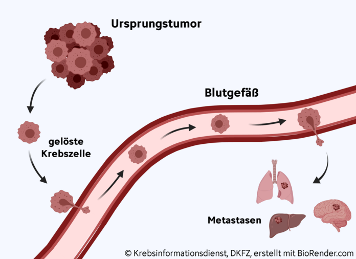 metastasenbildung, © Krebsinformationsdienst, DKFZ; erstellt mit BioRender.com Graphische Darstellung zur Entstehung von Metastasen: Vom Ursprungstumor lösen sich Krebszellen ab und gelangen über die Blutbahn in andere Organe. Dort bilden sie Metastasen.