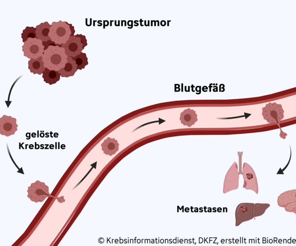 Graphische Darstellung zur Entstehung von Metastasen: Vom Ursprungstumor lösen sich Krebszellen ab und gelangen über die Blutbahn in andere Organe. Dort bilden sie Metastasen.