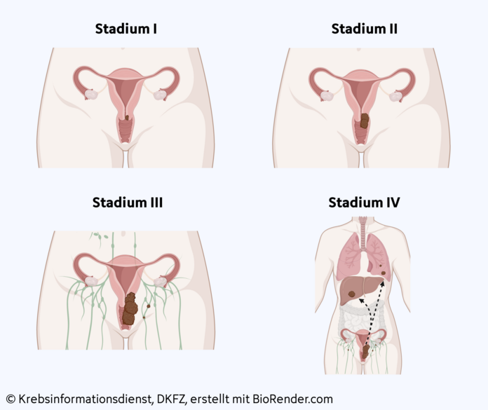 Gebärmutterhalskrebs, Stadien, © Krebsinformationsdienst, DKFZ; erstellt mit BioRender.com Grafische Darstellung der Stadieneinteilung bei Gebärmutterhalskrebs.