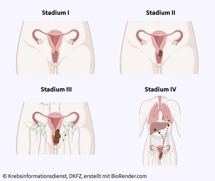 Gebärmutterhalskrebs, Stadien, © Krebsinformationsdienst, DKFZ; erstellt mit BioRender.com Grafische Darstellung der Stadieneinteilung bei Gebärmutterhalskrebs.