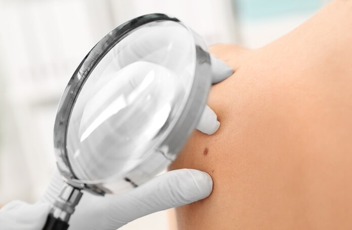 Hautkrebs-Früherkennung, © Africa Studio, Shutterstock Ein Hautarzt untersucht mit einer Lupe die Haut eines Patienten.