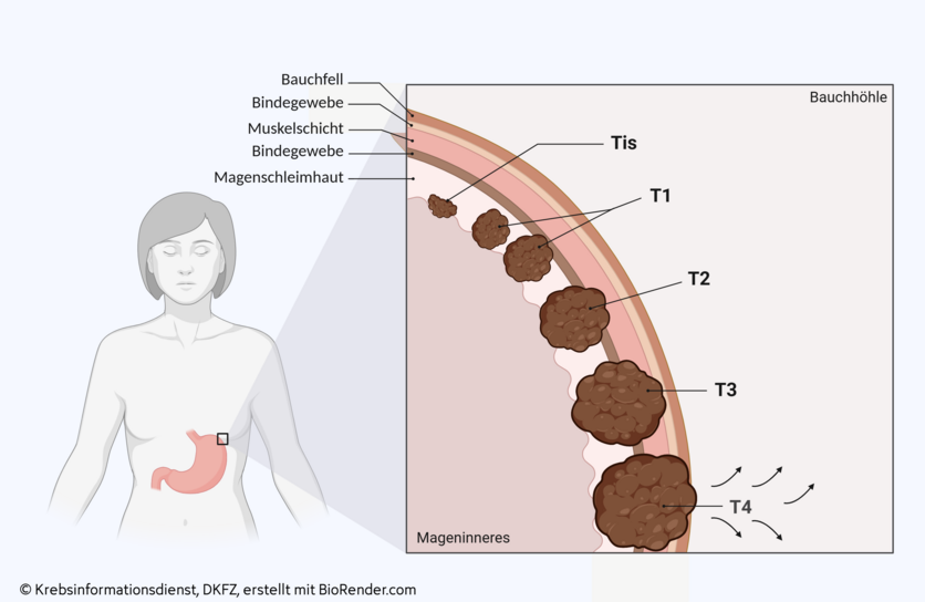 Grafik eines vergrößerten Abschnitts der Magenwand bestehend aus Magenschleimhaut, Bindegewebeschicht, Muskelschicht und einer zweiten Bindegewebeschicht (von innen nach außen gesehen). Eingezeichnet sind die Tumorstadien Tis-T4.