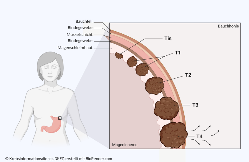 Tumorstadien Magenkrebs, © Krebsinformationsdienst, DKFZ; erstellt mit BioRender.com Grafik eines vergrößerten Abschnitts der Magenwand bestehend aus Magenschleimhaut, Bindegewebeschicht, Muskelschicht und einer zweiten Bindegewebeschicht (von innen nach außen gesehen). Eingezeichnet sind die Tumorstadien Tis-T4.