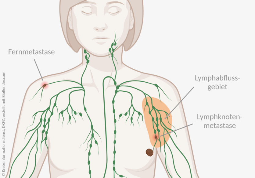 Brustkrebs: N-Status und M-Status im Vergleich , © Krebsinformationsdienst, DKFZ; erstellt mit BioRender.com Infografik eines weiblichen Oberkörpers mit einem Tumor in der linken Brust. Das Lymphabflussgebiet ist markiert, darin ist eine Lymphknotenmetastase eingezeichnet. In der entfernten, rechten Schulter ist eine Fernmetastase in einem Lymphknoten dargestellt.