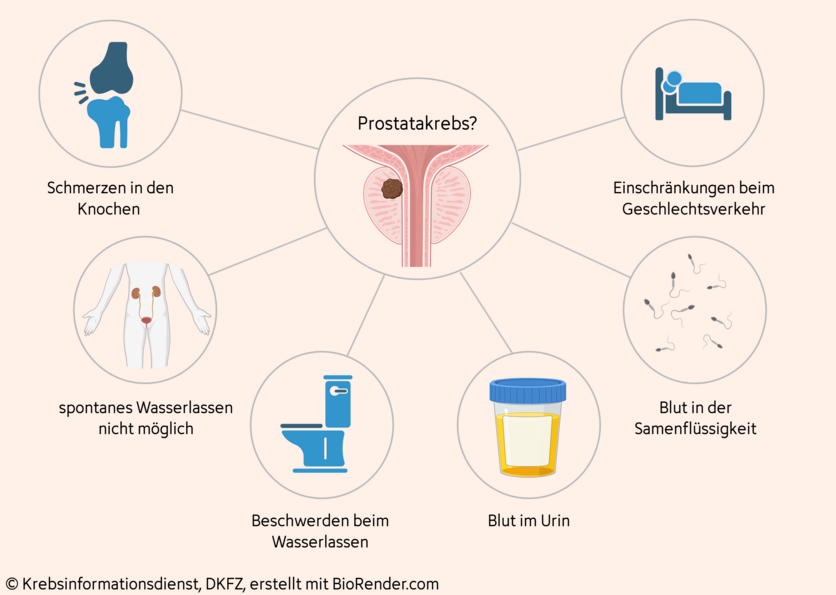 Symptome von Prostatakrebs, © Krebsinformationsdienst, DKFZ; erstellt mit Biorender.com Mindmap möglicher Beschwerden bei Prostatakrebs: Knochenschmerzen, Blut in Urin oder Samenflüssigkeit, Beschwerden beim Wasserlassen, spontanes Wasserlassen nicht möglich und Einschränkungen beim Geschlechtsverkehr.