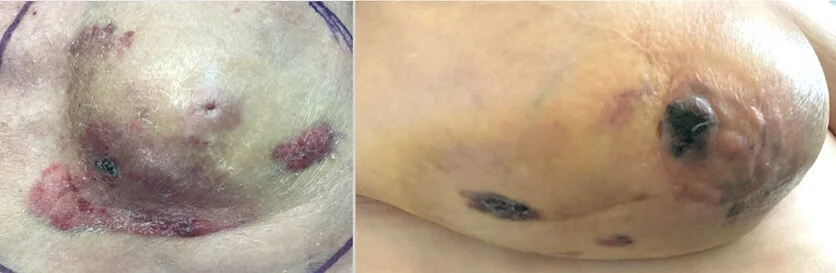 RIAS fortgeschritten Patientin B (rechte Brust) Bild 3 und 4, © Sarkomzentrum der Universitätsmedizin Mannheim Zwei klinische Fotografien einer rechten Brust inklusive Brustwarze. Diese zeigen großflächige, dunkelviolette Verfärbungen sowie unebene und geschwollene Hautbereiche.