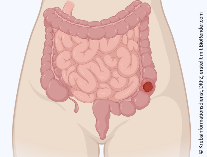 Tumor im Dickdarm, © Krebsinformationsdienst, DKFZ; erstellt mit BioRender.com Schematische anatomische Abbildung des Darmtraktes mit leuchtendem Tumor im Dickdarm.