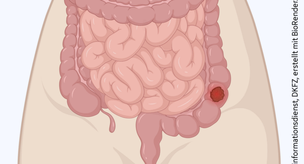 Tumor im Dickdarm, © Krebsinformationsdienst, DKFZ; erstellt mit BioRender.com Schematische anatomische Abbildung des Darmtraktes mit leuchtendem Tumor im Dickdarm.
