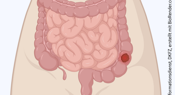Schematische anatomische Abbildung des Darmtraktes mit leuchtendem Tumor im Dickdarm.